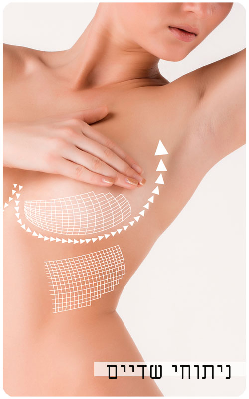 ניתוחי שדיים